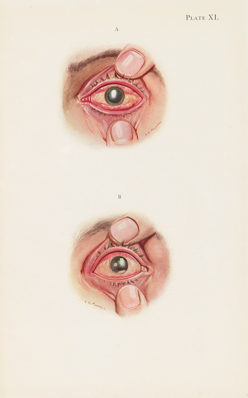 A. Kirkpatrick Maxwell - Plate XI. A. Severely burned eye in the acute stage. B. Slightly later stage of acute burning