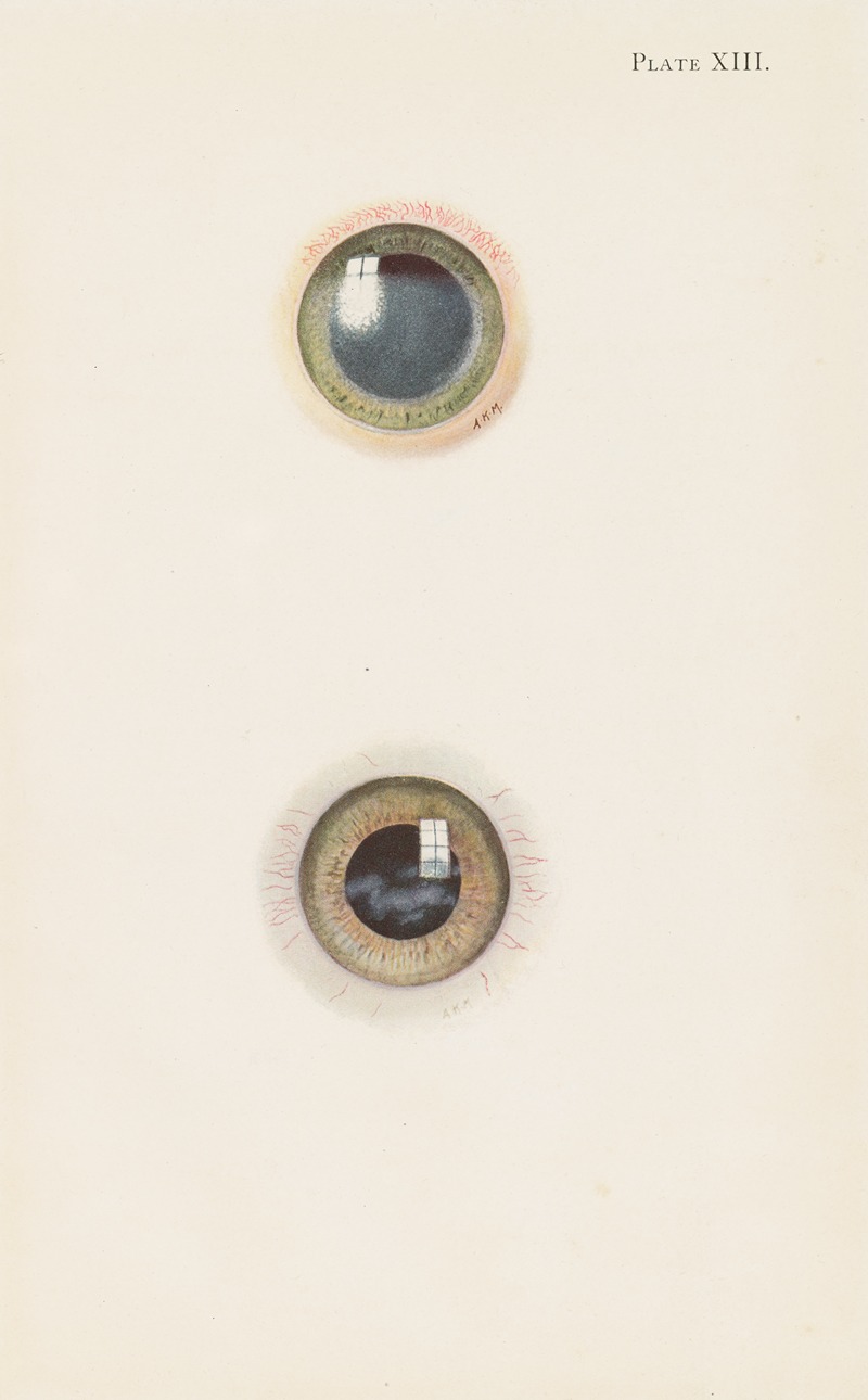 A. Kirkpatrick Maxwell - Plate XIII. A. Drawing of the cornea in the acute stage of severe burning. B. Drawing of cornea in the stage of resolution after severe burning