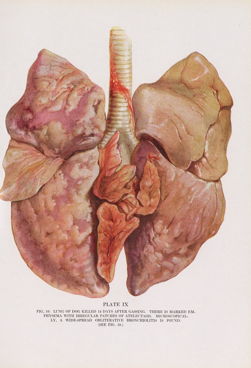 Milton C. Winternitz - Plate IX (Fig. 16): Lung of dog killed 14 days after gassing.