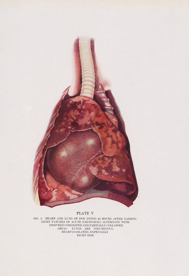 Milton C. Winternitz - Plate V (Fig. 1): Heart and lung of dog dying 24 hours after gassing.