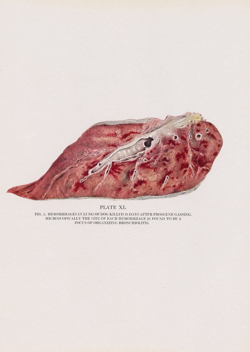 Milton C. Winternitz - Plate XL (Fig. 1): Hemorrhages in lung of dog killed 10 days after phosgene gassing.