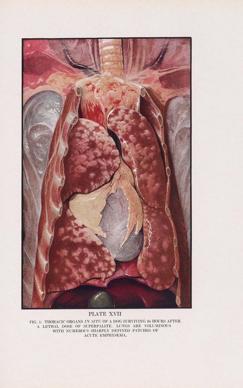 Milton C. Winternitz - Plate XVII (Fig. 1): Thoracic organs in situ of a dog surviving 24 hours after a lethal dose of superpalite.