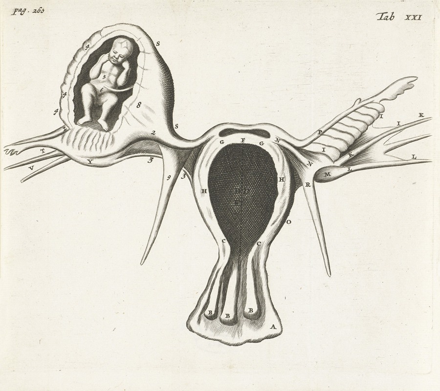 Hendrik Bary - Anatomical image of an ectopic pregnancy.