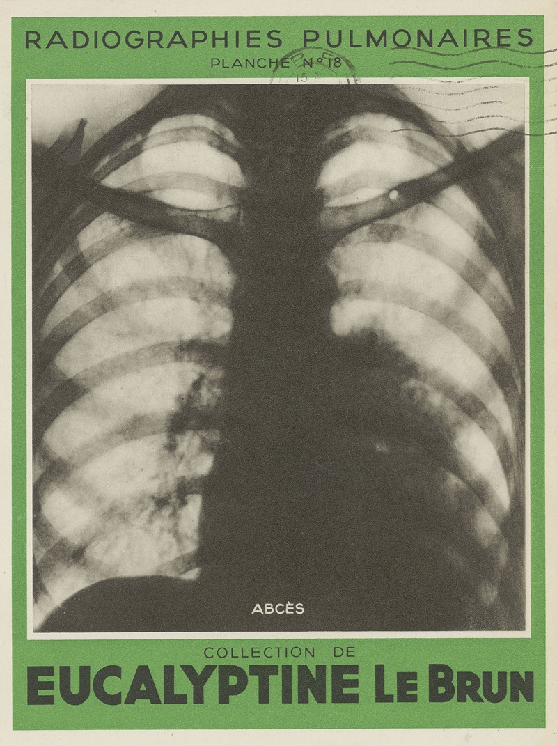 Anonymous - Abcès