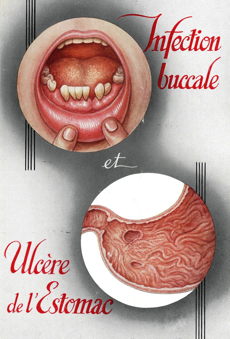 Anonymous - Infection buccale et ulcère de l’estomac