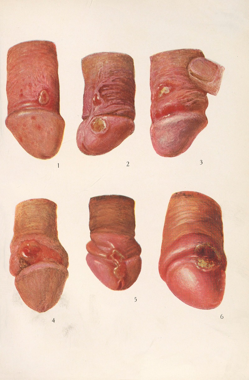 Feliks Malinowski - Venereal diseases – Syphilis Pl.01