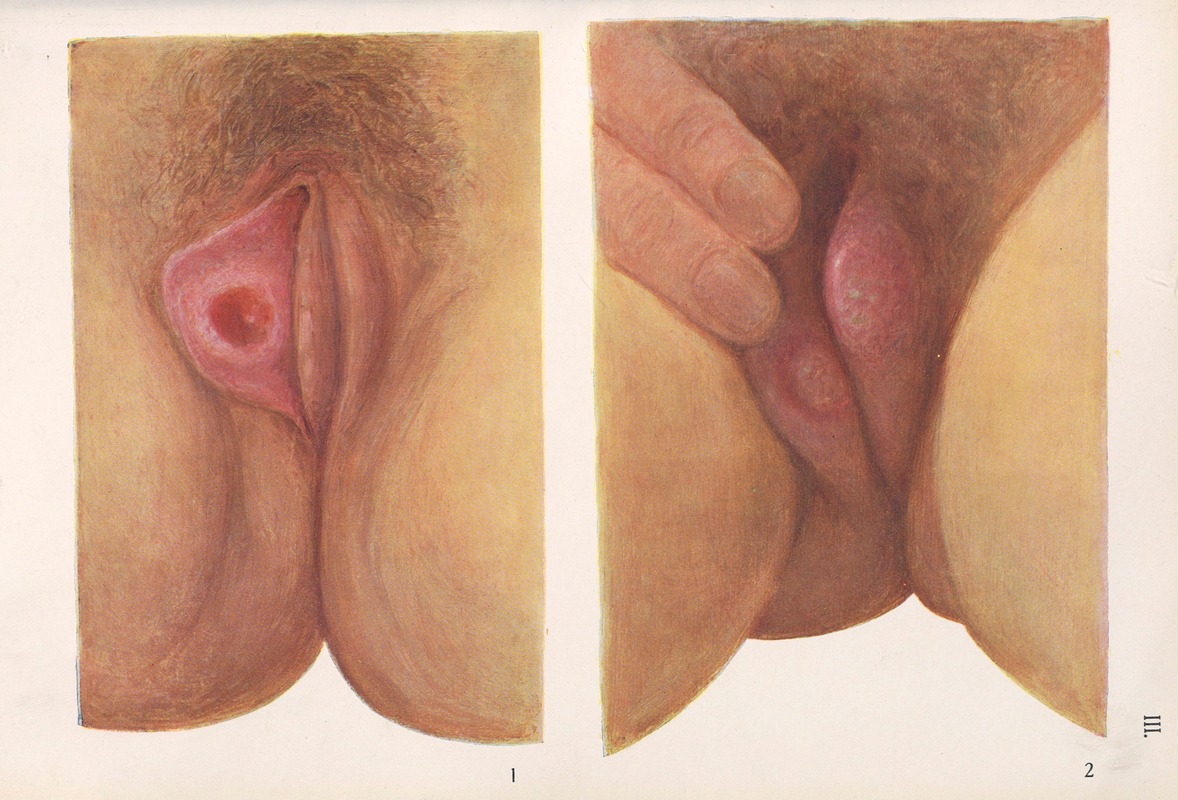 Feliks Malinowski - Venereal diseases – Syphilis Pl.03