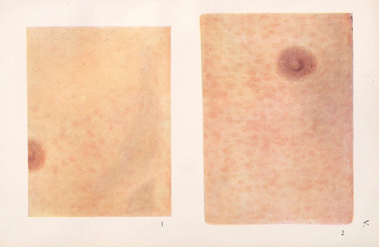 Feliks Malinowski - Venereal diseases – Syphilis Pl.05