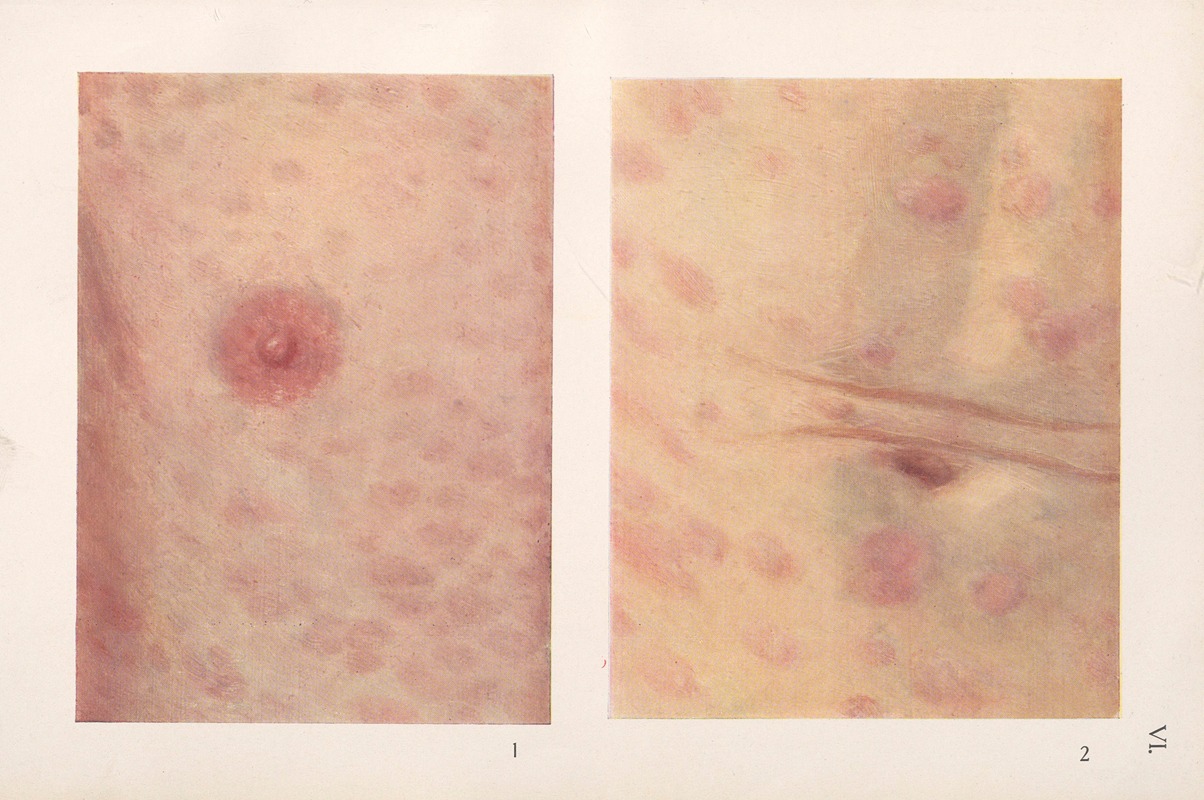 Feliks Malinowski - Venereal diseases – Syphilis Pl.06