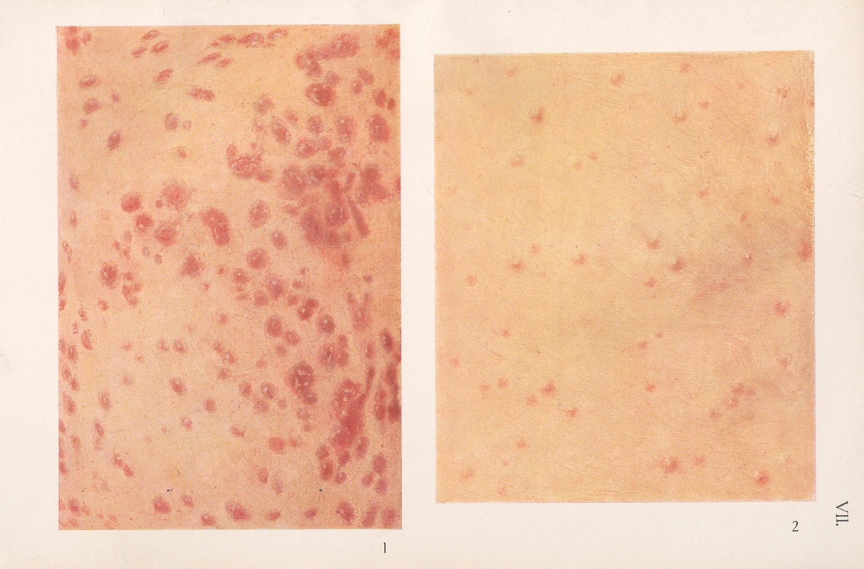 Feliks Malinowski - Venereal diseases – Syphilis Pl.07