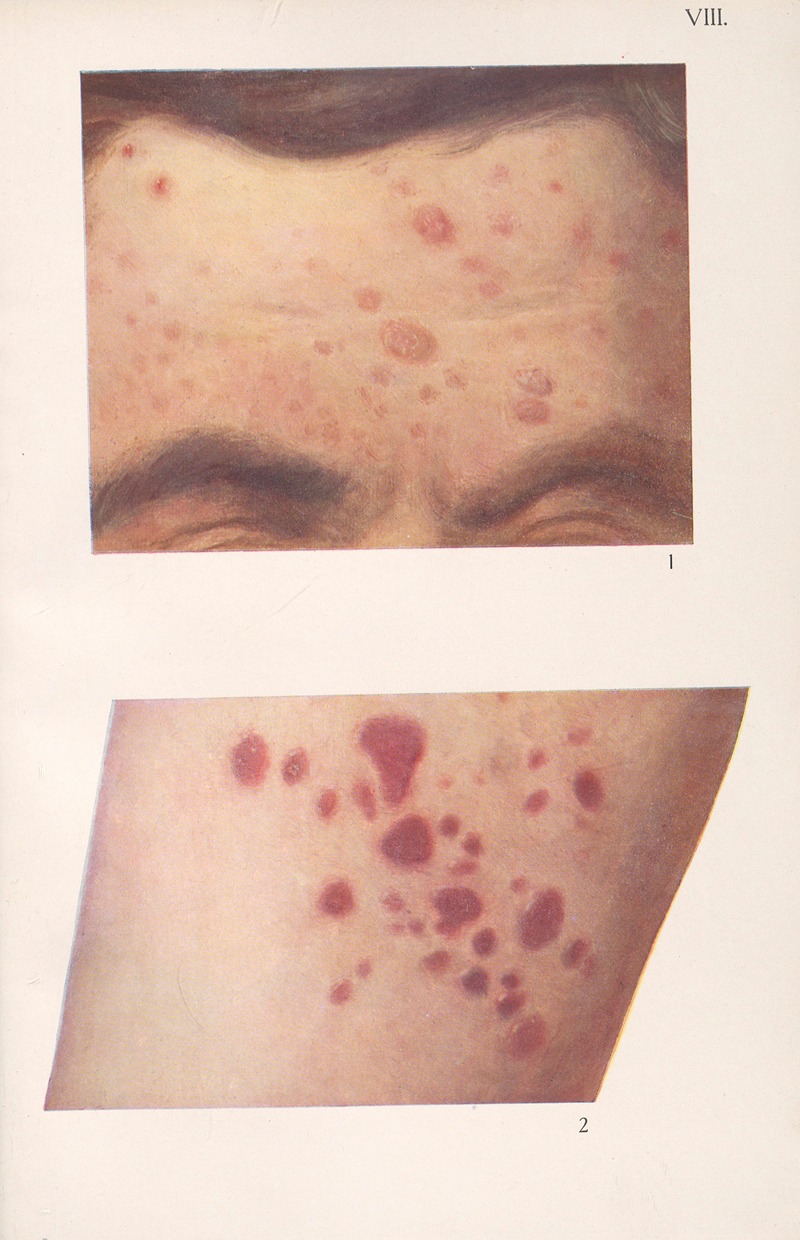 Feliks Malinowski - Venereal diseases – Syphilis Pl.08