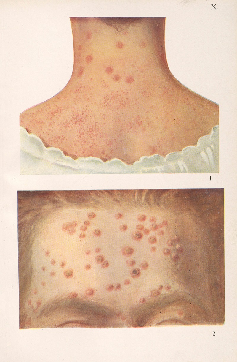 Feliks Malinowski - Venereal diseases – Syphilis Pl.10