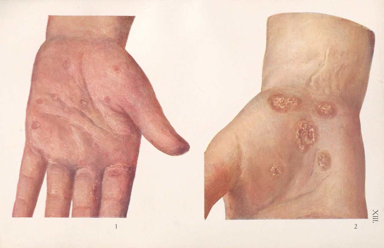 Feliks Malinowski - Venereal diseases – Syphilis Pl.13