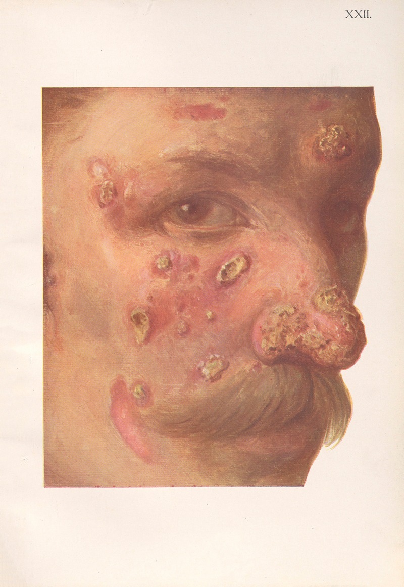 Feliks Malinowski - Venereal diseases – Syphilis Pl.22