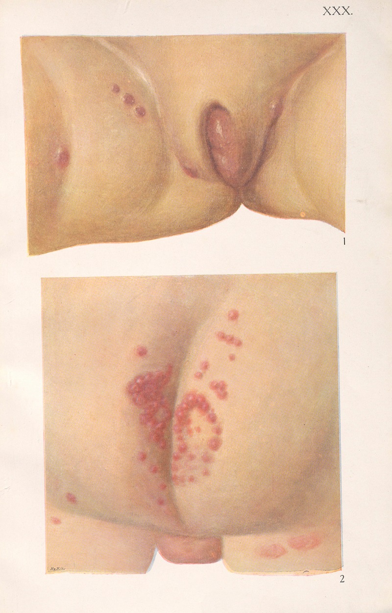 Feliks Malinowski - Venereal diseases – Syphilis Pl.30